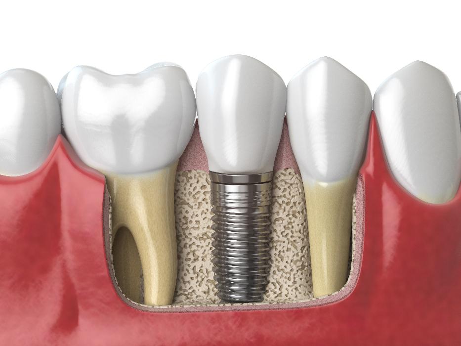implant restoration tazewell va