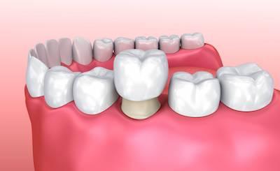 dental crown illustration