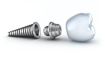 image of a dental implant in tazewell va