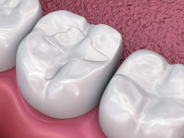dental filling in Tazewell VA