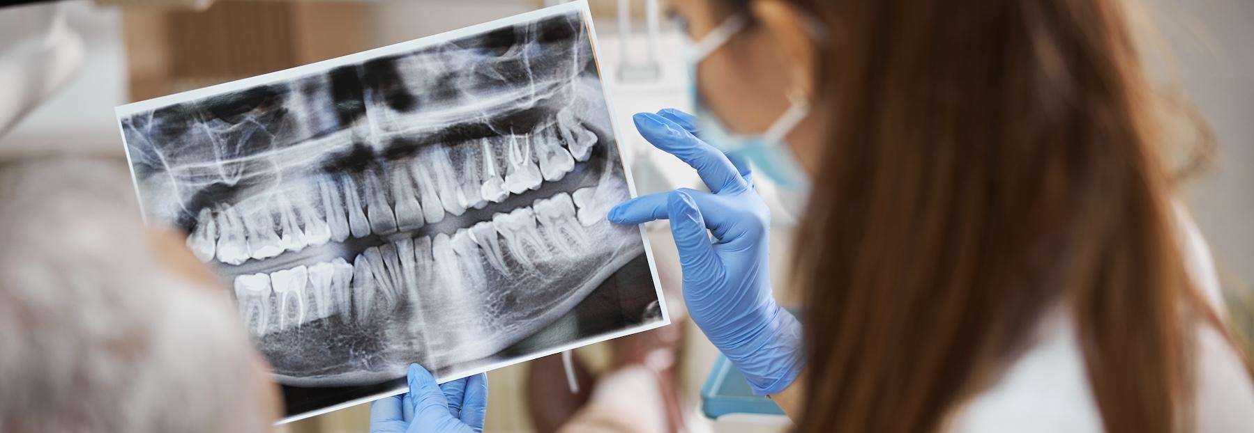Dental X Ray result in RA May, DDS